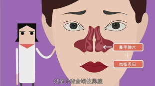 不要让鼻甲肥大影响你的生活