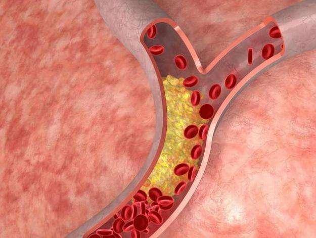 血脂怎样检查才准确 214b6c39648645d0aa5d621a7115d61f.jpeg