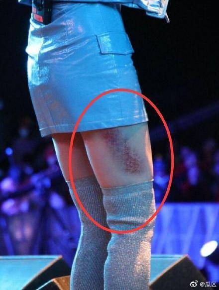 伤痕|黄龄摔倒后首现身，腿蒙着纱布伤痕明显，网友：这看上去就好痛啊