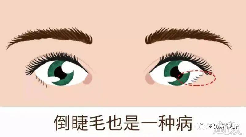 下眼皮倒睫怎么办