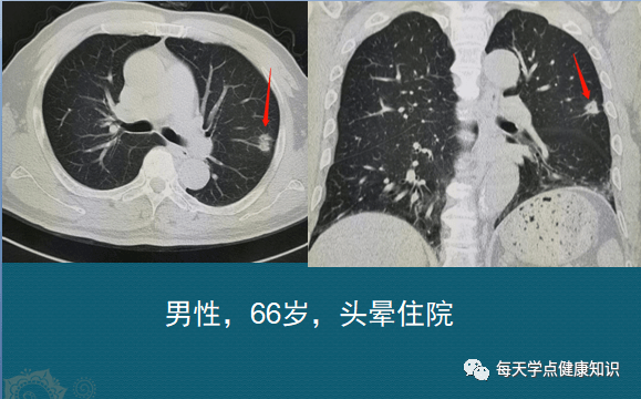 肺部硬结灶怎么办