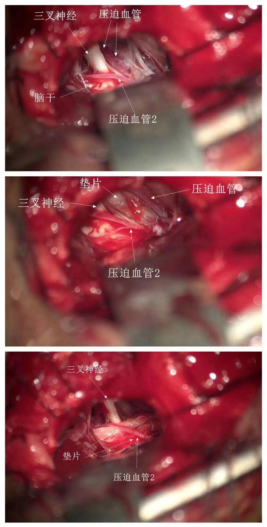 有种撕心裂肺叫做三叉神经痛比分娩痛还可怕