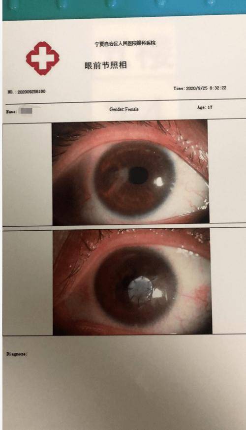 警惕丨宁夏17岁女孩眼睛长螨虫,眼角膜穿孔,视力几乎丧失