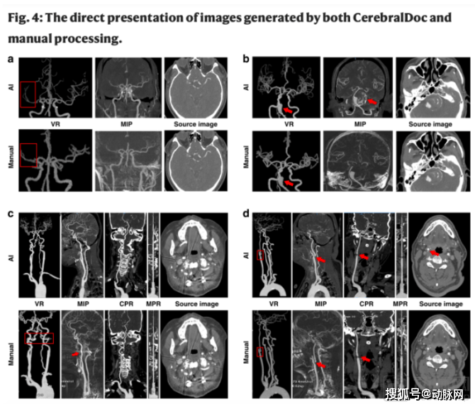 Nature|《Nature》子刊收录宣武医院CTA研究，AI重塑临床流程