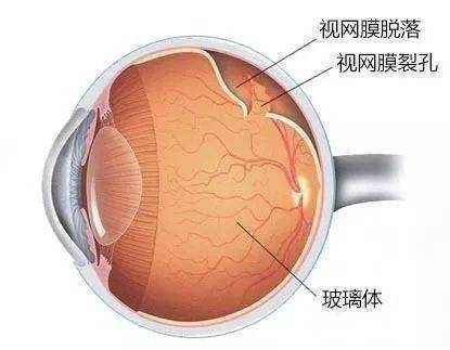 多少度会遗传近视 9aaa2af9b08e4184ac8c15a159d860b8.jpeg