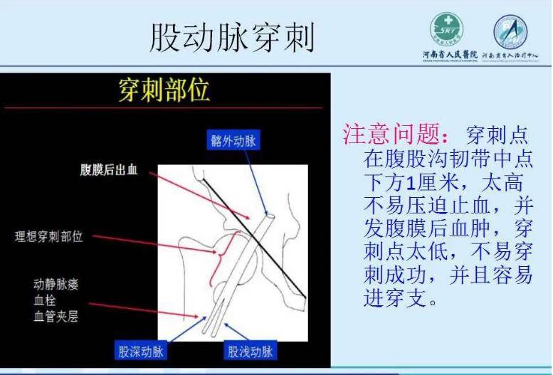 股动脉,胧动脉,桡动脉动脉穿刺评价血管内介入治疗策略