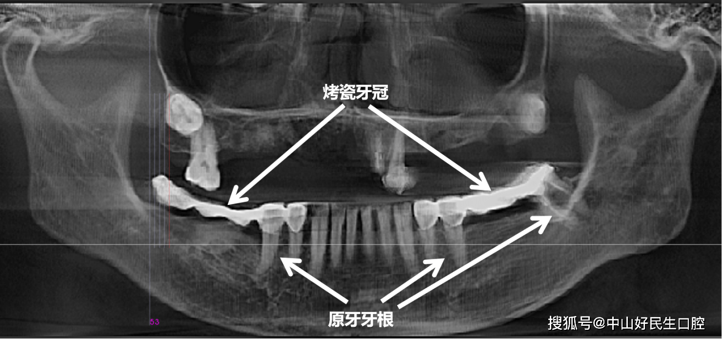 她用了15年,修复了一半牙齿