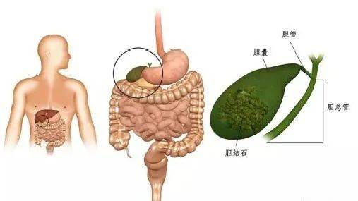 胆摘除的人口_胆摘除照片