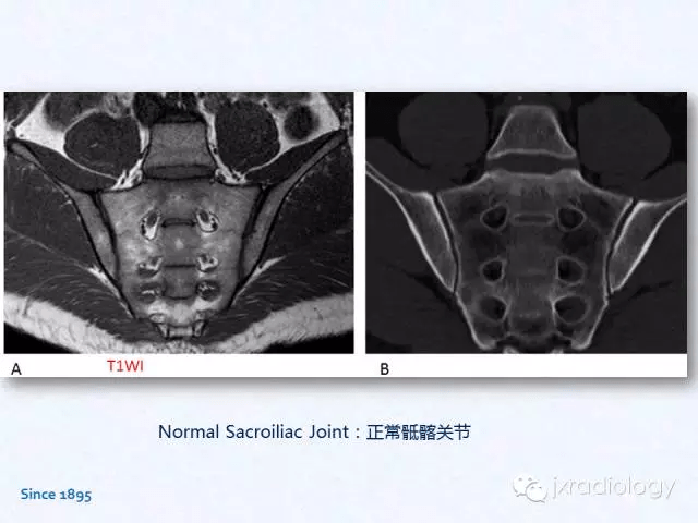 骶髂关节炎:x线,ct和mri表现