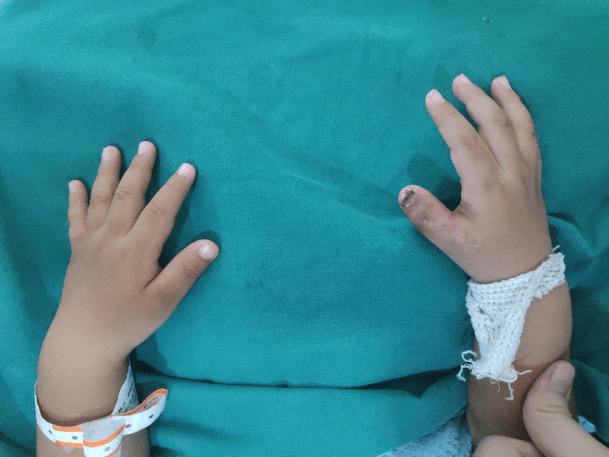 10个月宝宝右手有六指广州医生手术成功为他切除了多指