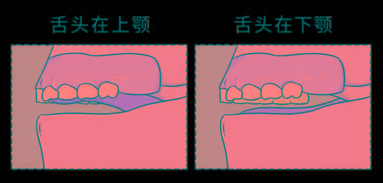 下唇"地包天",牙齿不齐或前凸,习惯用单侧牙齿咀嚼等都是用嘴呼吸的