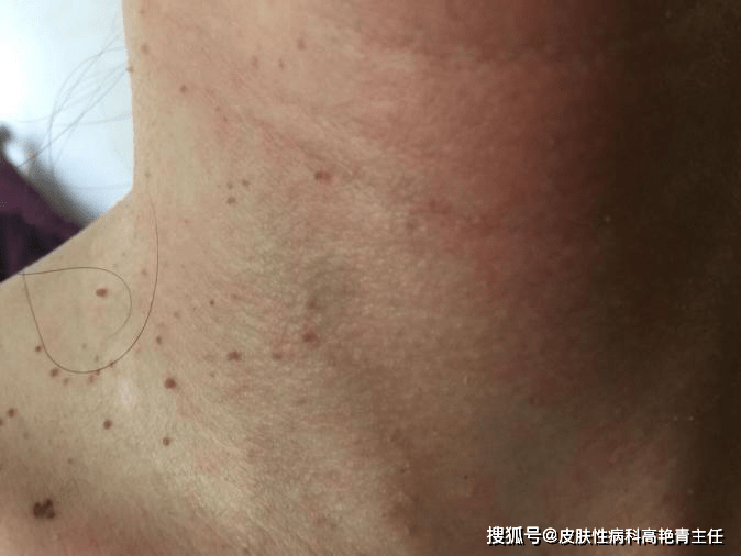 脖子腋下长了好多小突起,痒痒的,还会越长越多,你知道这是什么吗?