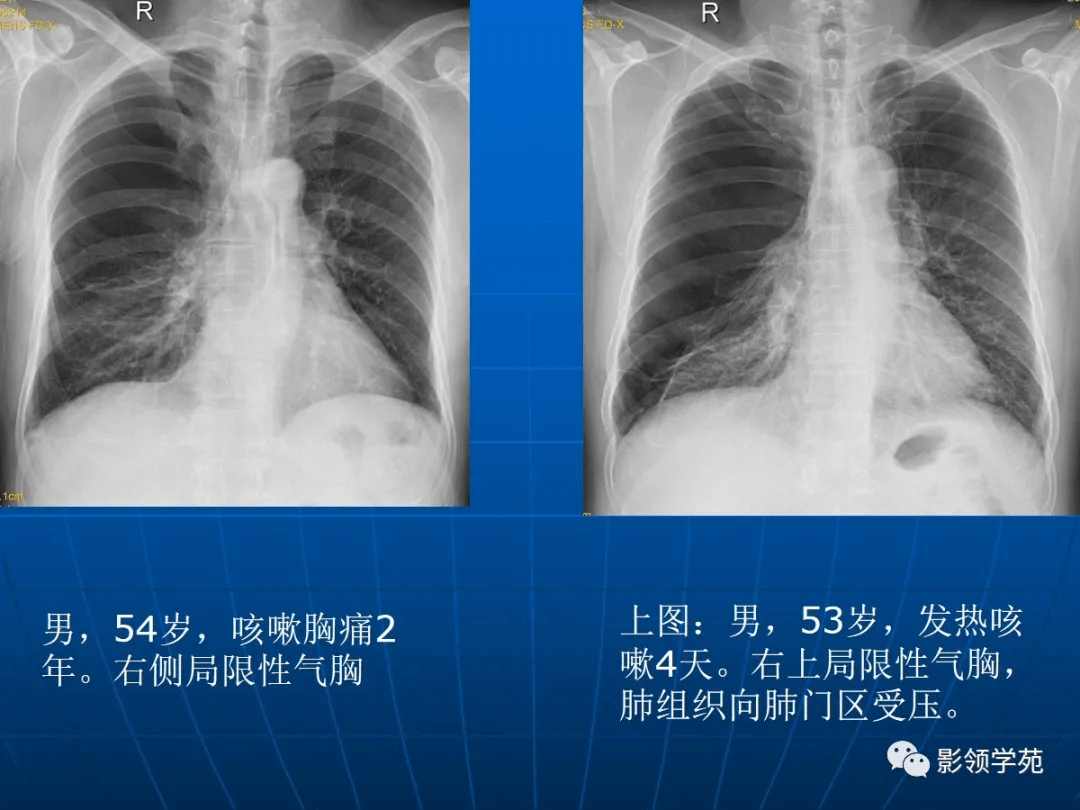 肺气肿的影像诊断