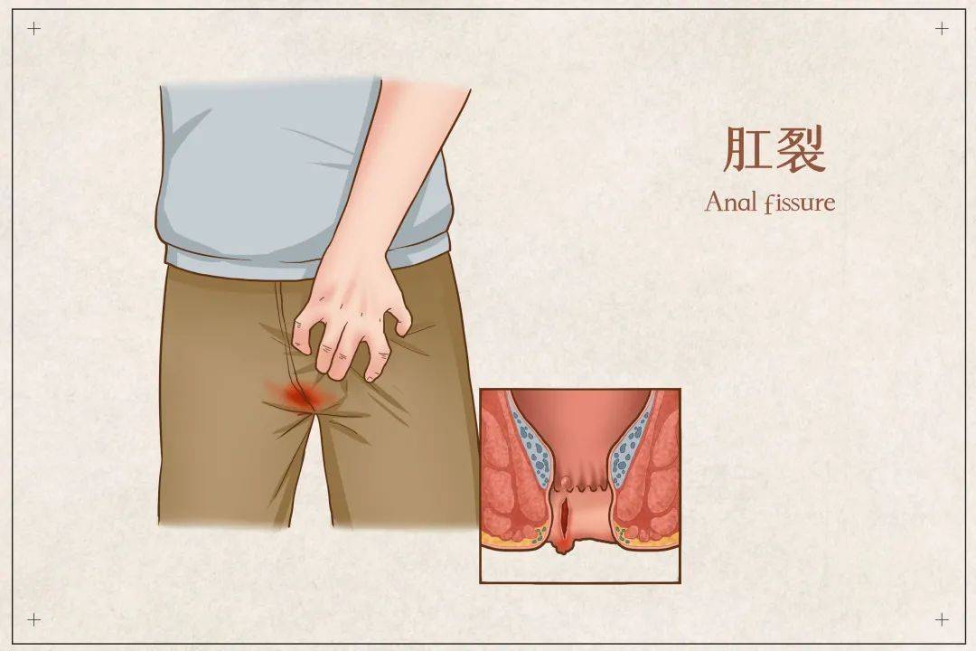三,肛窦炎