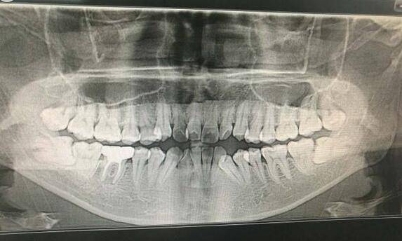 拔除松动牙一定要拍一个全景片