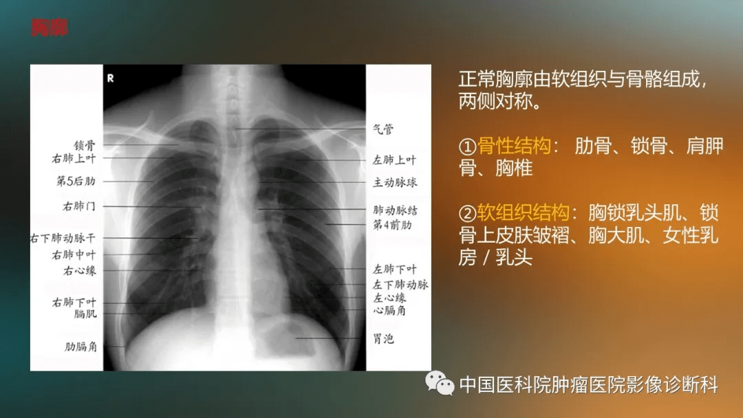 基于胸片的胸部正常解剖及变异