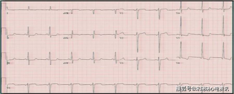 带你了解常见心肌病的心电图表现