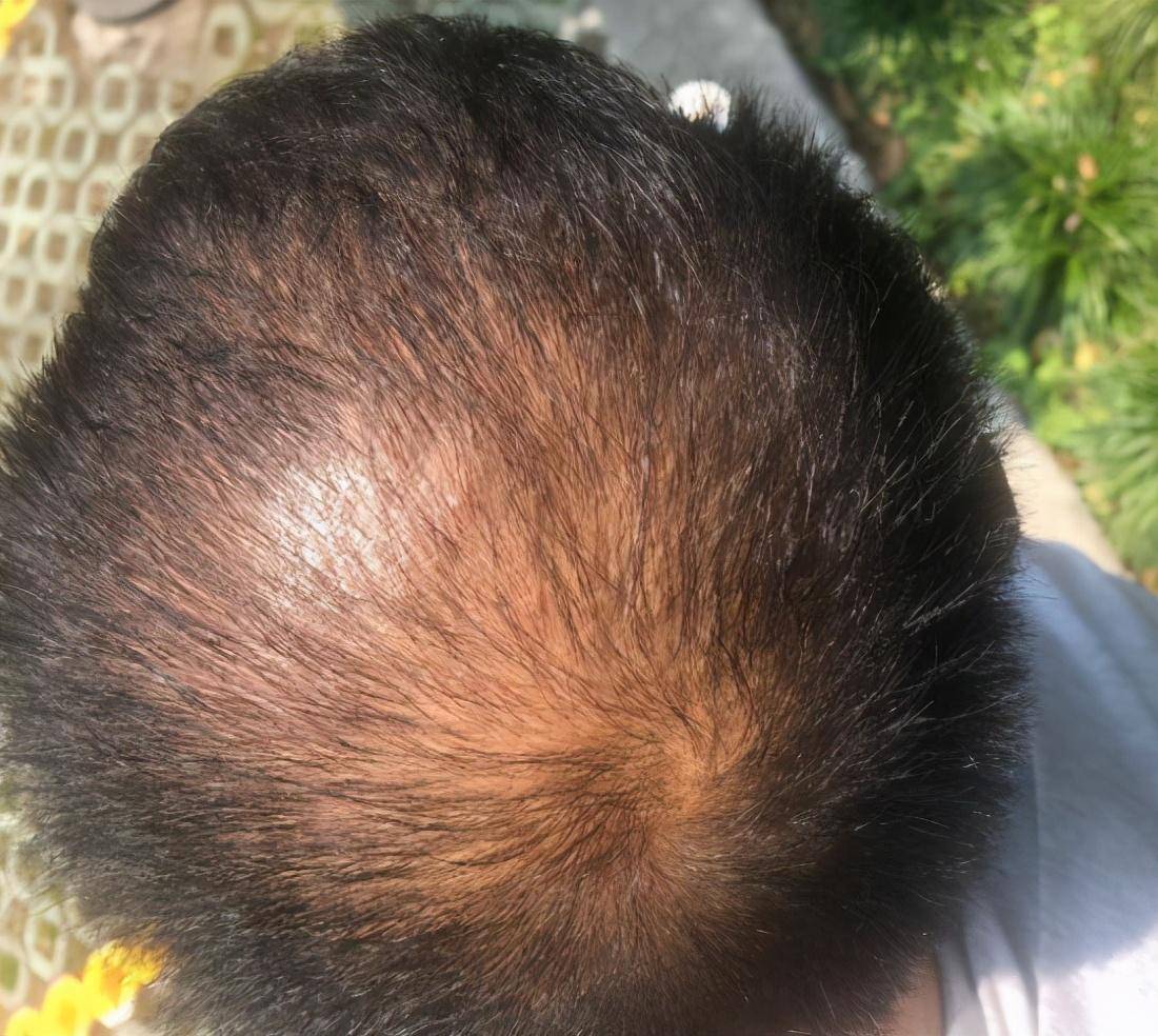 25岁男子头顶脱发不去医院,轻信网红带货的洗发水,结果头更秃了