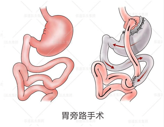 手术|难以察觉的糖尿病，谁也没想到自己会成为糖尿病“后备军”的一员