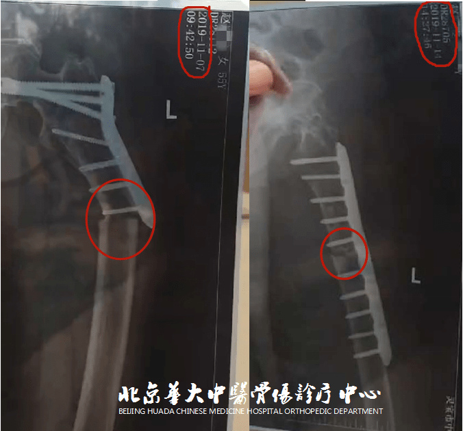 10个月股骨干骨折骨不连患者治疗案例