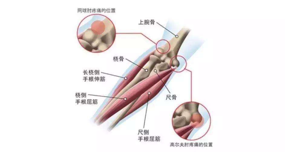 网球肘的自我治疗方法 这样治疗网球肘比较好