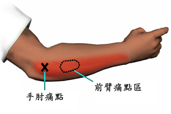 网球肘的自我治疗方法 这样治疗网球肘比较好