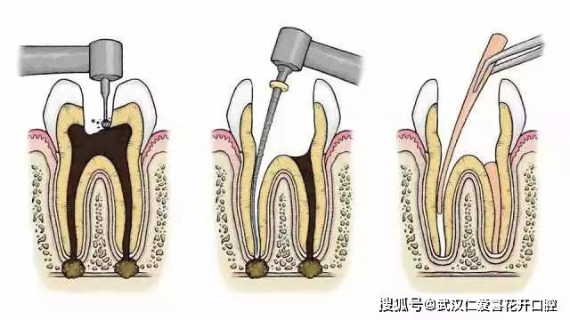 什么是根管治疗和打桩做冠?_牙齿