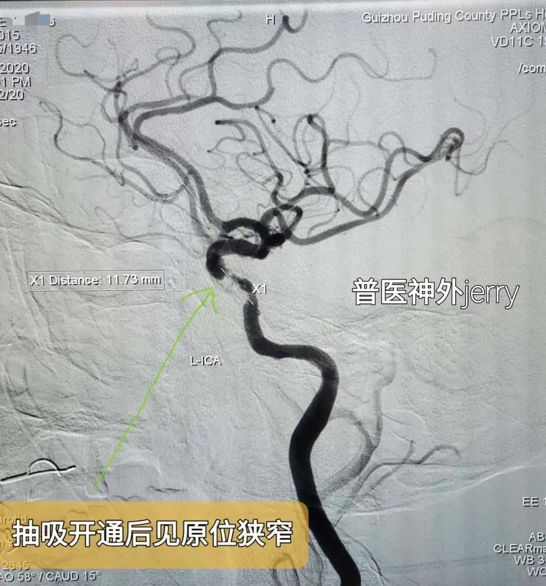 家属|卒中绿色通道，让生命跑过死神