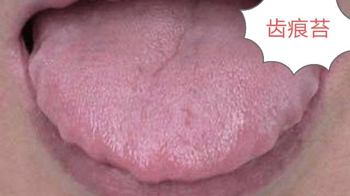 舌体,舌苔都偏白,说明脾肾阳虚,身体内有水湿痰饮.