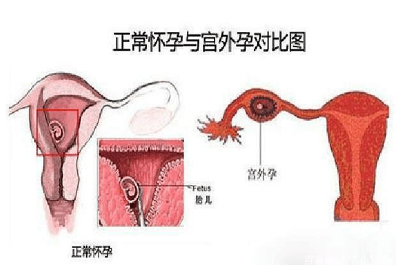 怀孕绞病是什么原理_绞龙砂是什么砂子(2)