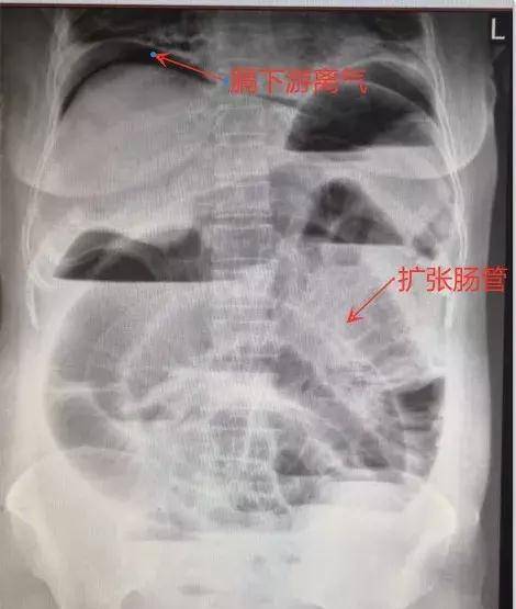 原创广西一女子腹胀,腹痛一个多月!肚子里竟然有个15cm长的粪石