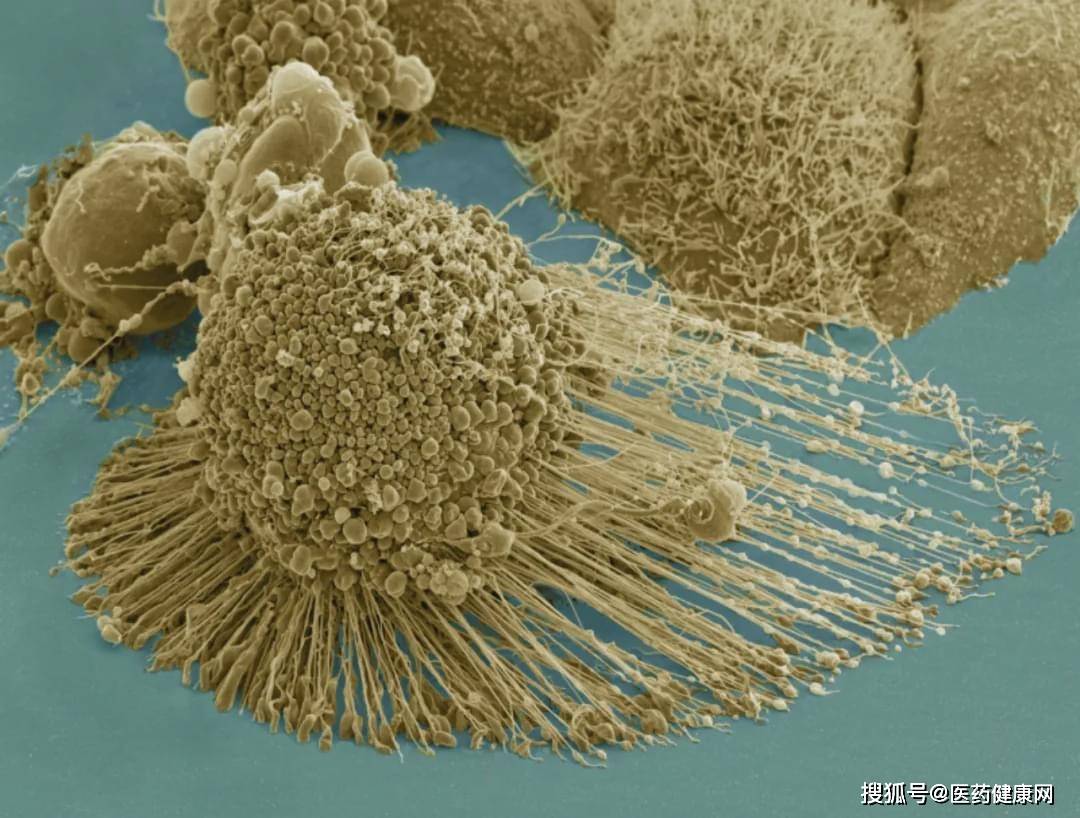 电子显微镜下,正在凋亡的一个海拉细胞.