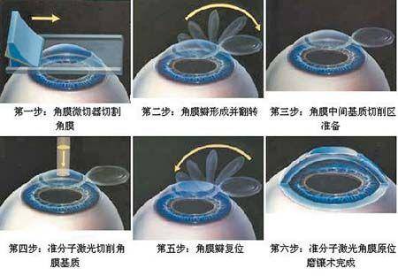 适合人群:不能戴框架眼镜或不适合戴隐形眼镜的;参军,参加特殊职业