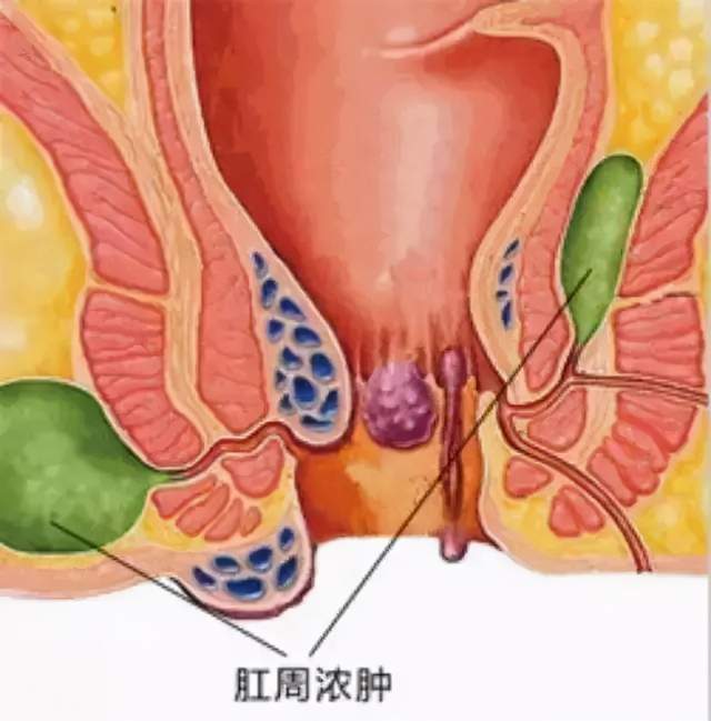 肛周脓肿示意图,左侧位于坐骨直肠窝,右侧位于骨盆直肠窝.