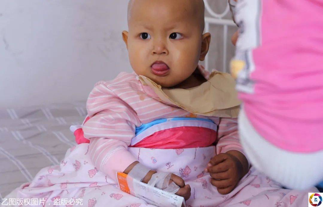 怪物|大如气球,妈妈心痛却束手无策四川2岁小萝莉肚里长“怪物”