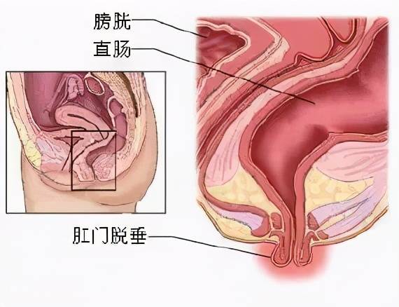 直肠脱落怎么办