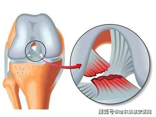 起于股骨外侧髁部的内侧向前下方止于胫骨平台的内侧髁间棘,其功能是