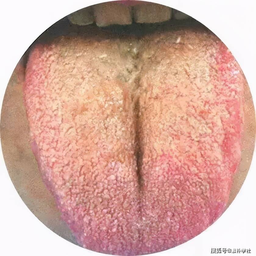中医舌诊:舌苔发黄的9个秘密