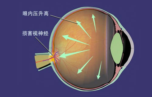 国外眼科专家详述:青光眼的症状是什么?如何诊断?