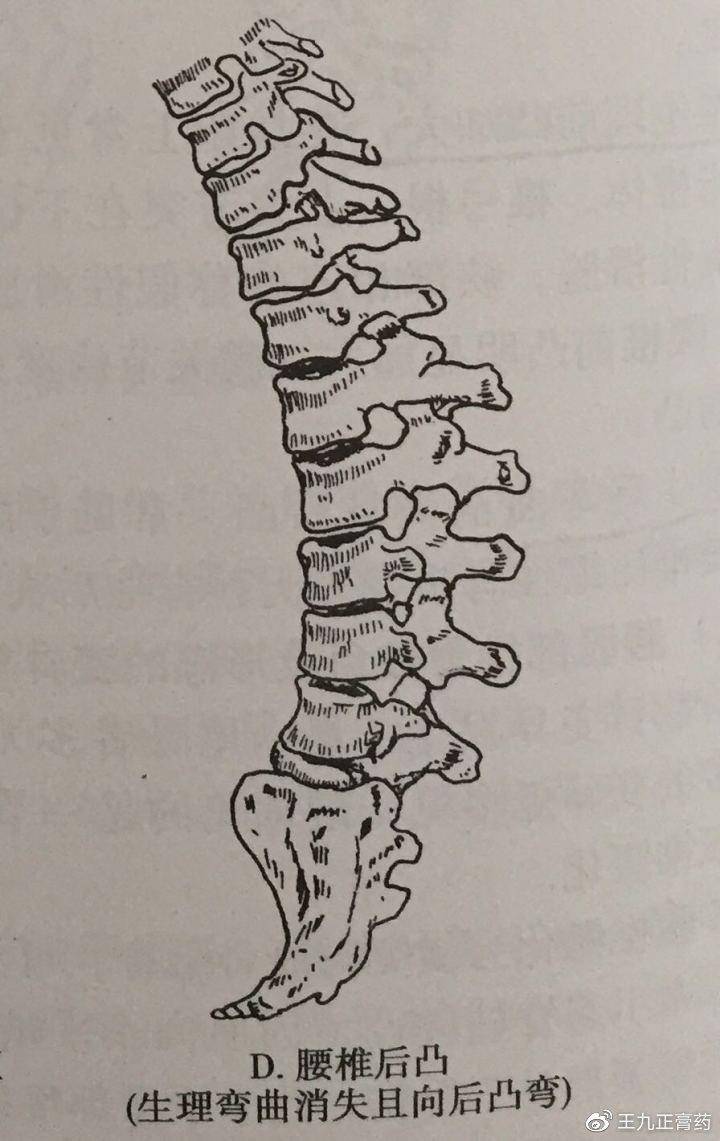 腰椎生理曲度改变,导致椎体受力改变,发生退变,形成骨刺,关节突关节