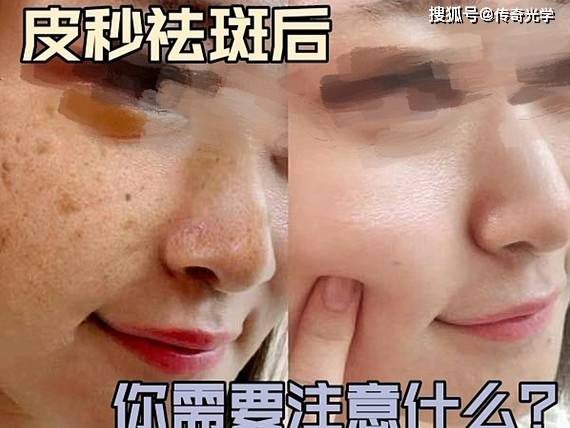 斑什么陆成语_蛇斑疮是什么症状图片