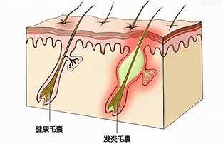 头发得了毛囊炎怎么办