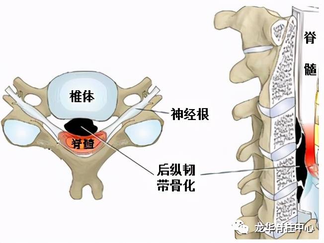 颈椎后纵韧带骨化是怎么回事?