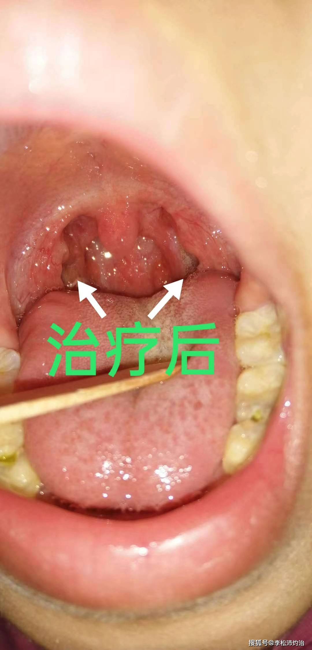 扁桃体肥大不手术可以治好吗?有其他办法解决真的可以