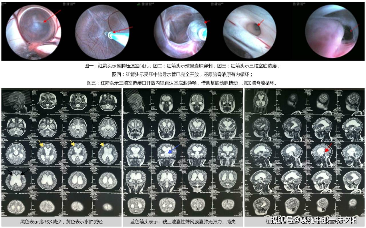 两岁患儿的鞍上池蛛网膜囊肿伴脑积水案例