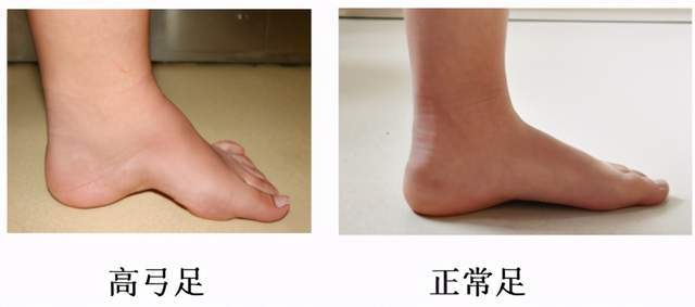 足弓的高度超过正常形态的足称为高弓足,高弓足不单单是足弓的高度