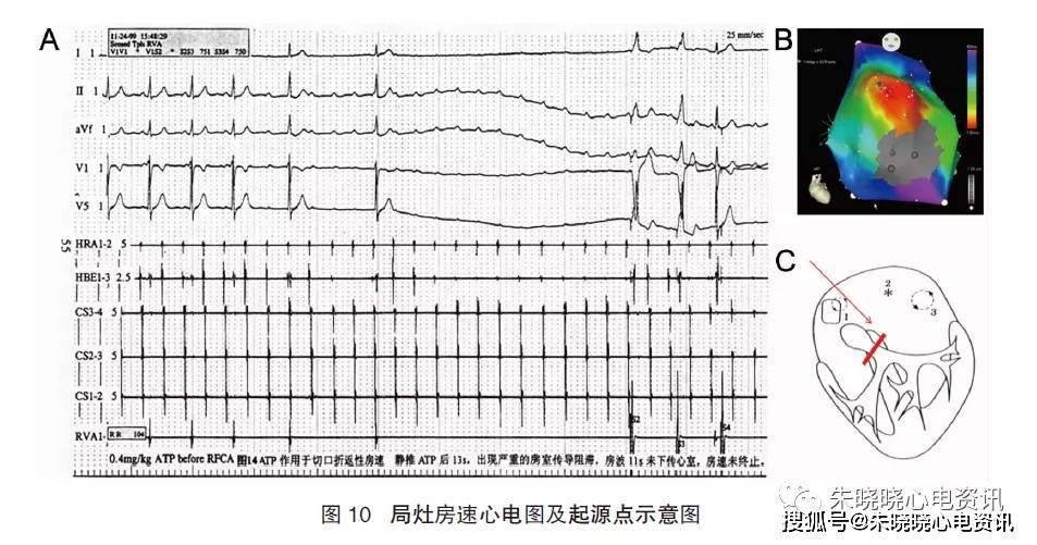 esc 成人室上速管理指南,你掌握了吗?