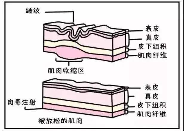 去皱针什么原理_打去皱针初期吓人图片