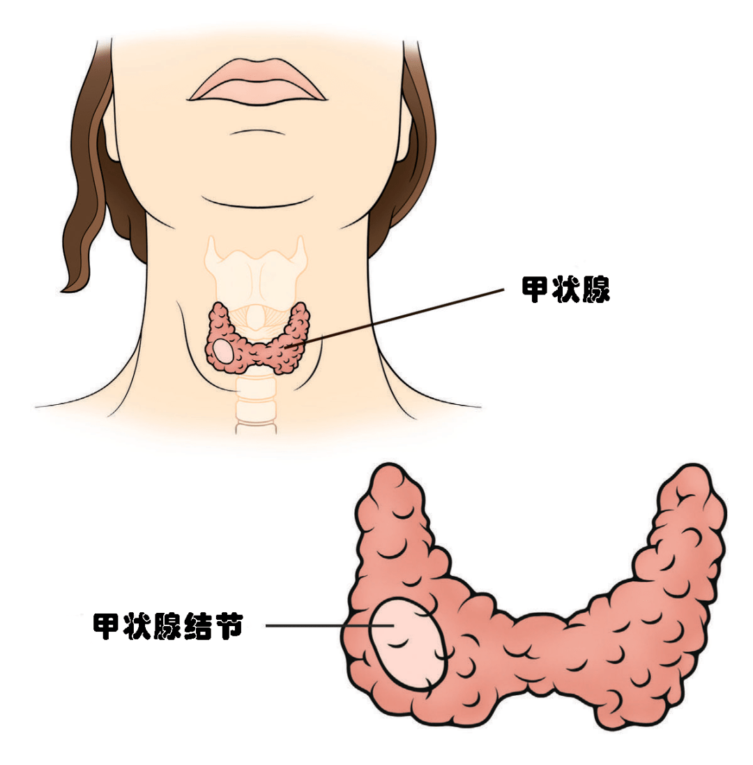 4个甲状腺疾病的误区,你中招了吗