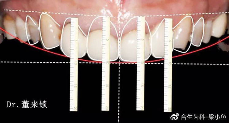 再确定前牙牙龈缘高度,长宽比例,大小比例,最终绘制牙齿形态.